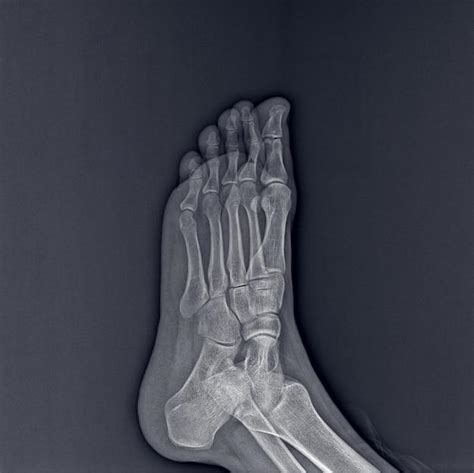 How Long Does It Take to Recover from 5th Metatarsal Surgery? - AP PGECET