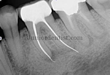 Root Canal Treatment Failure Causes And What Is Re Rct