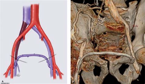 Venous Bypass Basicmedical Key