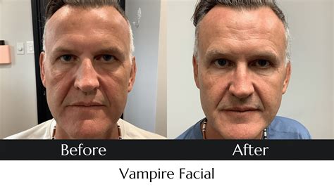 Vampire Facial