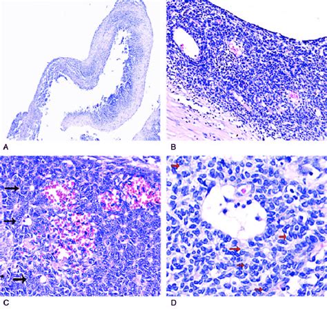 Photomicrograph Hematoxylin And Eosin Staining A The Cyst Was Lined