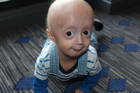 Progeria Lindsay