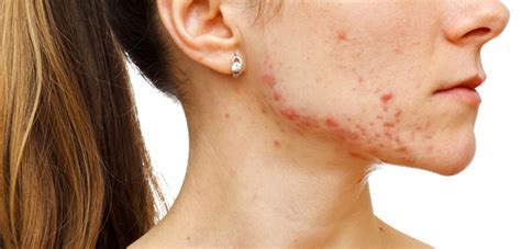 Wat Helpt Tegen Acne Littekens Alhydran