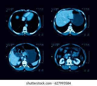 Computed Tomography Ct Scan Abdomen Contrast Stock Photo 627993584 ...