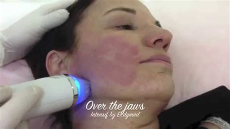 Intensif Rf Micro Needling From Endymed Youtube