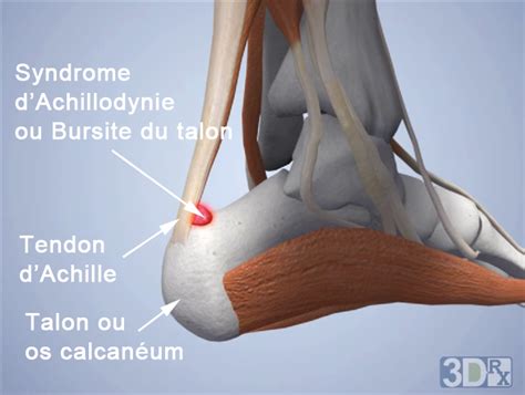 Bursite Calcifiante Et Traitement De Shockwave Sos Shockwave