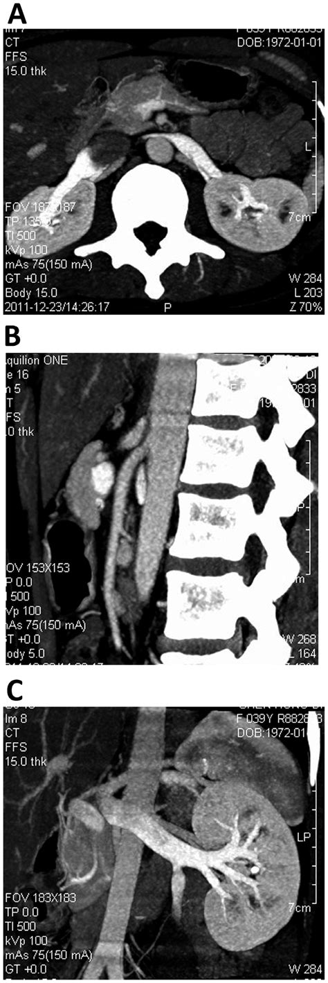 In A 38 Year Old Female Patient With Nutcracker Syndrome Download