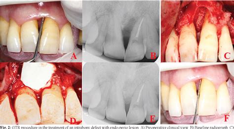 Pdf Comparison Of Gtr T Prf And Open Flap Debridement In The