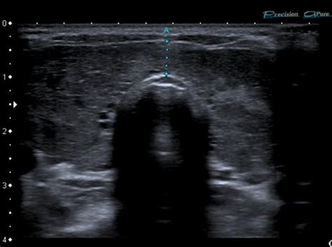 Graves Disease Thyroid Ultrasound