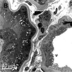 Ultrastructural findings via electron microscopy. Finely granular or ... 