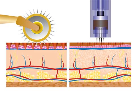 Dermapen Vs Derma Roller City Beauty Care