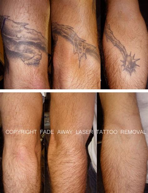 What Does Skin Look Like After Tattoo Removal