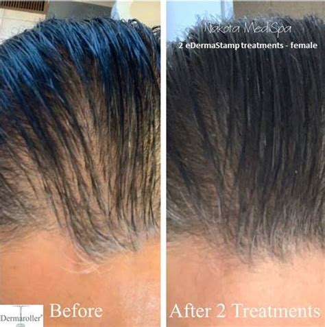 Hair And Scalp Treatment Dermaroller® Micro Needling Collagen