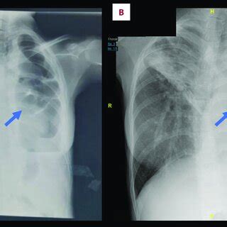 A B Chest X Ray At Months Of Pregnancy And Latest X Ray Arrow