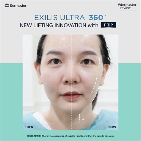 Exilis Ultra Ultimate Rf Ultrasound Lift At Dermaster