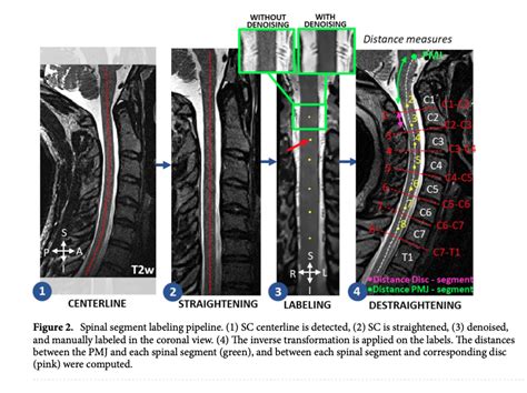 Pmj And Disc Based Labelling Mri Processing Spinalcordmri Org