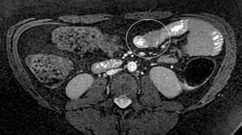 Atypical Sites Of Deeply Infiltrative Endometriosis Clinical Characteristics And Imaging