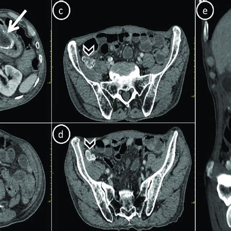 Axial A D And Sagittal Reconstructed E Contrast Enhanced Abdominal