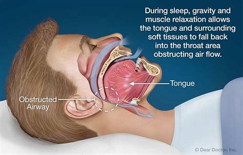 Snoring And Sleep Apnea Dr Charles Picchioni Bryn Mawr Pa