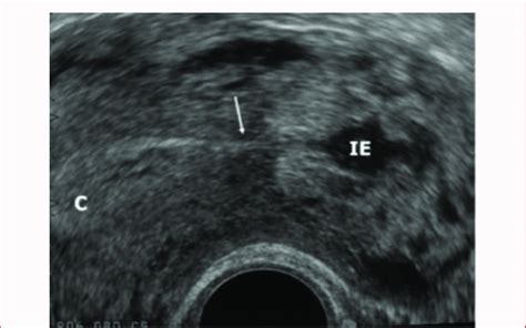 Ultrasound findings of Interstitial ectopic pregnancy (IE ...