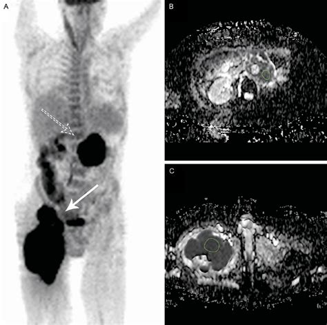 Coronal Fdg Pet A Axial Adc Map At The Para Aortic Region B And