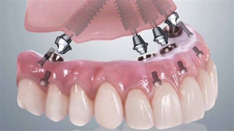 Pr Tesis Sobre Implantes Nuevos Implantes Dentales Medell N