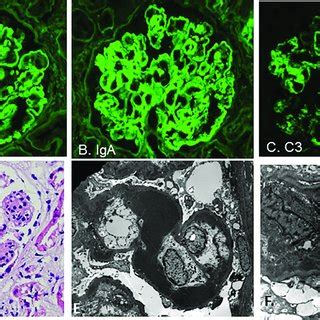 Light microscopy, immunofluorescence, and electron microscopy biopsy ...