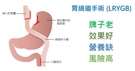 戰胖抗癌陳建翰醫師 常見的減重手術 二 腹腔鏡胃繞道手術