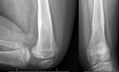 OrthoKids - Non Ossifying Fibroma