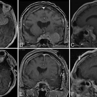 Preoperative A C And Postoperative D F T Weighted Post Gadolinium