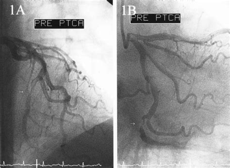 Posterior Anterior Pa Projection With Cranial Angulation Left A