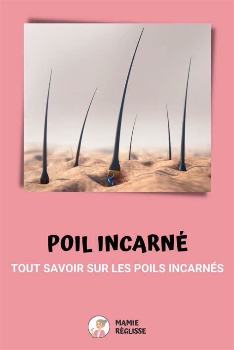 Solutions Naturelles Contre Les Poils Incarn S Pour Les Liminer