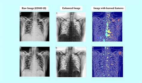 Ai Auto Scans Lung X Rays For Coronavirus Brunel University London