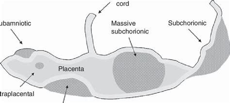 Different Sites Of Placental Abruption Download Scientific Diagram