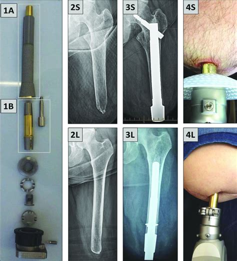 The Osseointegration Group Of Australia Accelerated Protocol OGAAP 1