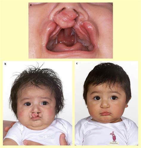 references  cleft lip  palate current management paediatrics  child health