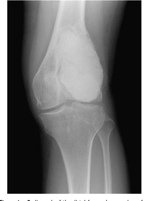 Figure From A Case Of Pulmonary Metastasis Of Giant Cell Tumor Of