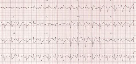 ECG Case 055 • LITFL • ECG Top 100 Self-Assessment Quiz