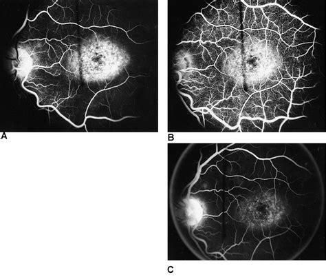 Cone dystrophy - American Academy of Ophthalmology