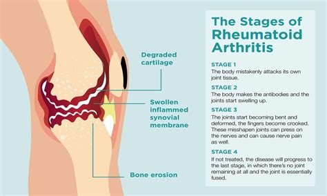 What Is Rheumatoid Arthritis