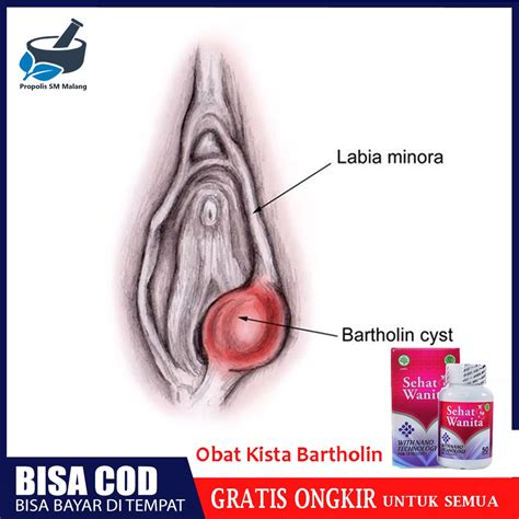 Jual Obat Kista Bartholin Kelenjar Bartholin Benjolan Di Vagina