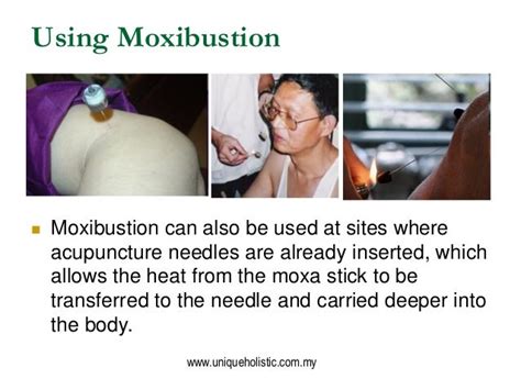 Moxibustion & Its Health Benefits