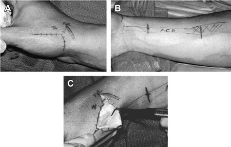 Figure 1 From Ligament Reconstruction And Tendon Interposition For