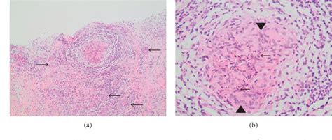 Figure From Idiopathic Granulomatous Mastitis Presenting As A Breast