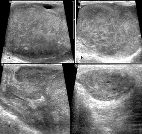 Ultrasound Of Scrotum Shows Bulky Left A And Right Testis B With