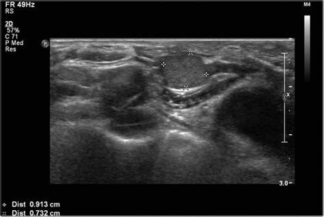 Frontiers Case Report Two Cases Of Recurrences At The Suprasternal