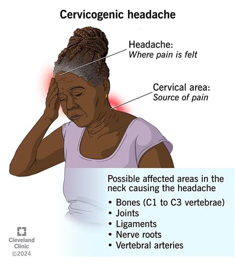 Cervicogenic Headache: What It Is, Symptoms & Treatment