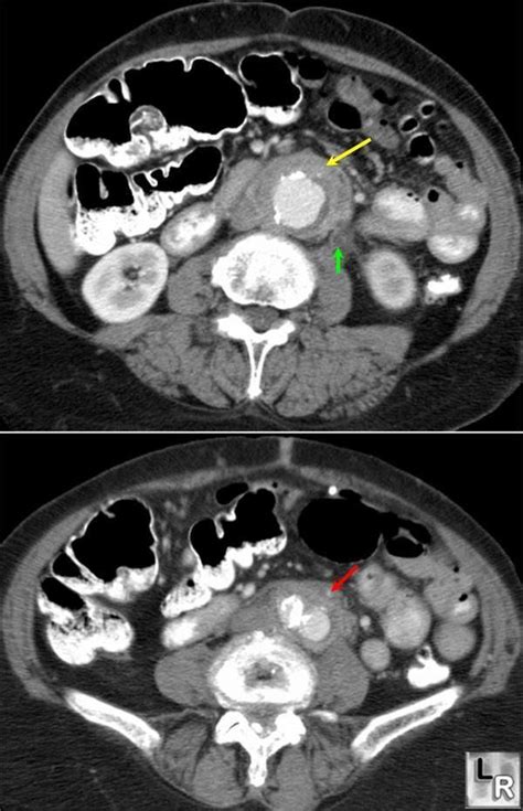 Fibrosis Retroperitoneal EcuRed