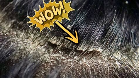 Scalp Scratch Off Big Flakes No More Extreme Dandruff Scratching And Removal Youtube