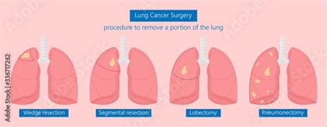 Vats Lung Cancer Treatment Sub Pus Tap Cell Open Tube Copd Rats Wedge Treat Tumor Lobar Blebs